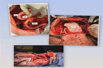 برای نخستین‌بار در جهان، برداشت کامل دوطرفه ریه‌ها