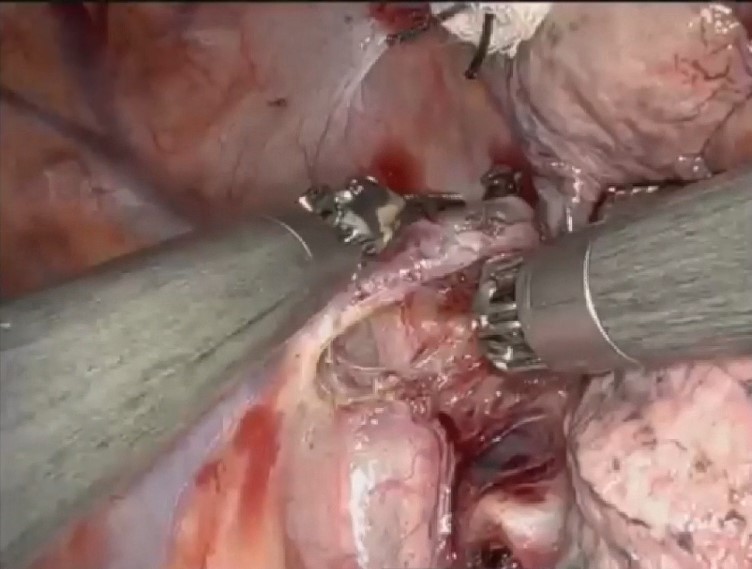 جراحی پیشرفته لوبکتومی اسلیو فوقانی راست رباتیک با فلپ چرخشی ورید آزیگوس